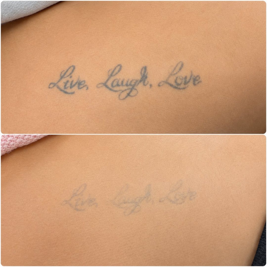 Laserfjernelse af tatovering i Esbjerg – Effektiv fading af tekst-tatovering før og efter laserbehandling