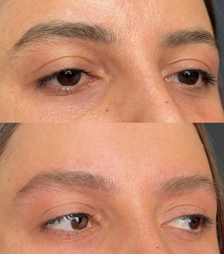 Laserfjernelse af permanent makeup Esbjerg - Fjernelse af pmu bryn før og efter